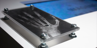 Imagen de radiografía de una mano, al lado una pantalla